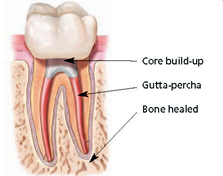 Root Canal