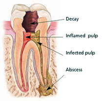 Root Canal